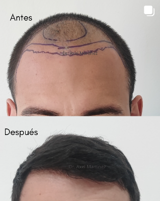 Antes y después real de restauración capilar